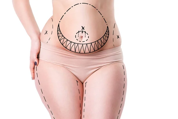 Liposuccion, graisse et concept d'élimination de la cellulite, corps féminin en surpoids avec lignes peintes et flèches — Photo