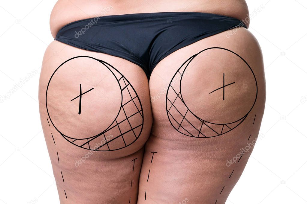 Liposuction, fat and cellulite removal concept, overweight female body with painted lines and arrows