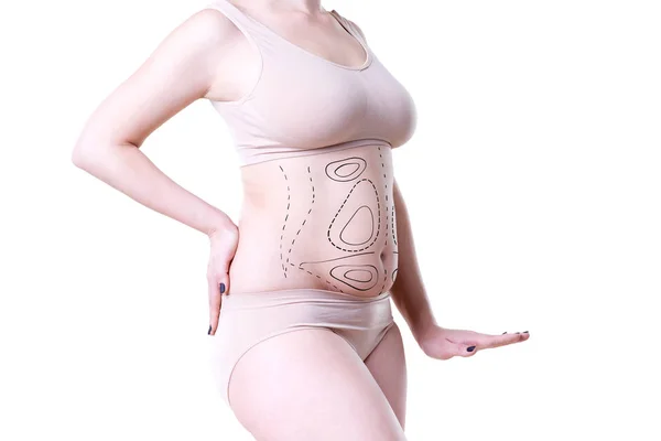 Fettabsaugung, Fett- und Celluliteentfernungskonzept, übergewichtiger weiblicher Körper mit aufgemalten Linien und Pfeilen — Stockfoto
