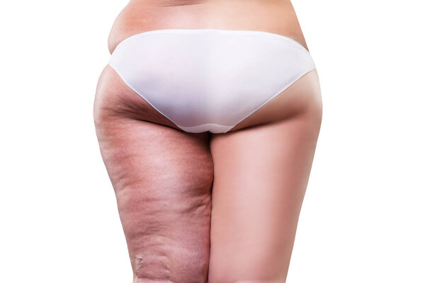 Overweight woman with fat cellulite legs and buttocks, before after concept, obesity female body, rear view