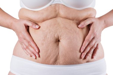 Tummy Tuck, yağlı göbek üzerinde gevşek cilt, plastik cerrahi kavramı