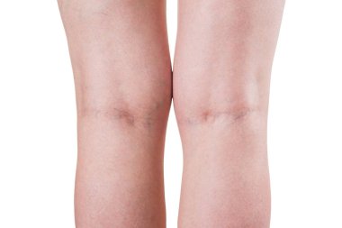 Varisli damarlar, beyaz arka planda izole kadın bacakları.