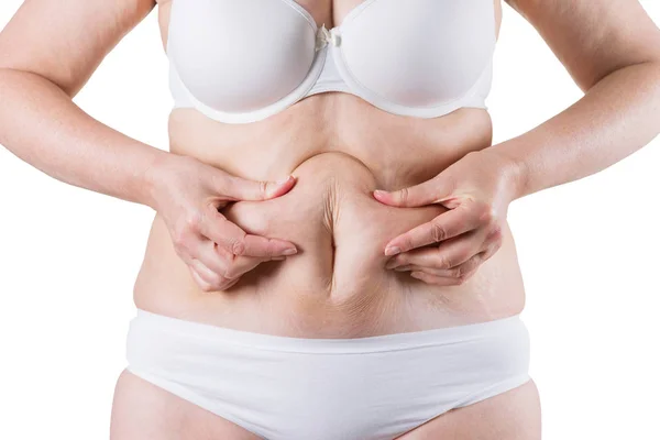 Abdominoplastia, piel flácida en un vientre gordo, concepto de cirugía plástica — Foto de Stock