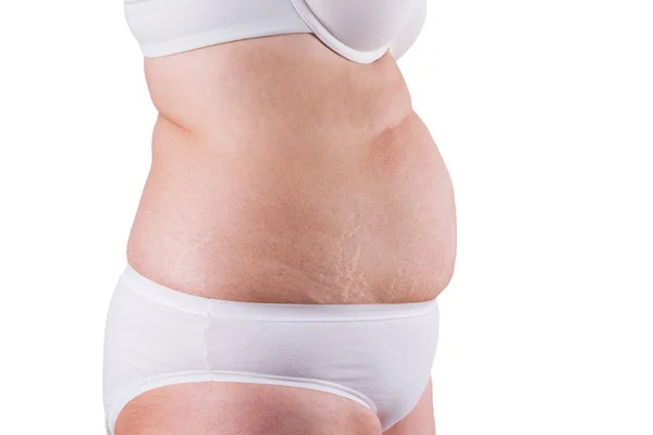 Tummy Tuck, slappe huid op een dikke buik, plastische chirurgie concept — Stockfoto