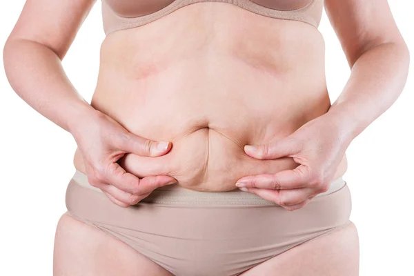 Tummy Tuck, slappe huid op een dikke buik, plastische chirurgie concept — Stockfoto