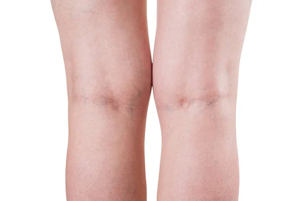 Venas varicosas, piernas femeninas aisladas sobre fondo blanco — Foto de Stock