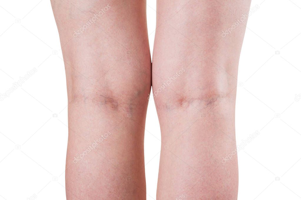 Varicose veins, female legs isolated on white background