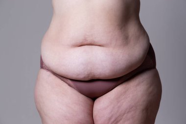Tummy Tuck, yağlı göbek üzerinde gevşek cilt, plastik cerrahi kavramı