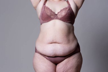 Tummy Tuck, yağlı göbek üzerinde gevşek cilt, plastik cerrahi kavramı