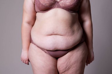 Tummy Tuck, yağlı göbek üzerinde gevşek cilt, plastik cerrahi kavramı