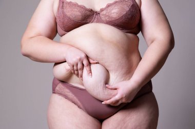 Tummy Tuck, yağlı göbek üzerinde gevşek cilt, plastik cerrahi kavramı