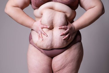 Tummy Tuck, yağlı göbek üzerinde gevşek cilt, plastik cerrahi kavramı