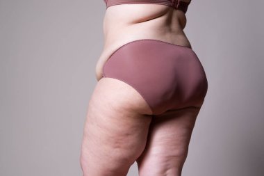 Kilolu kadın şişko bacak ve kalça, obezite kadın bedeni ile