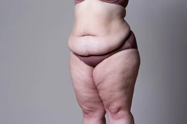 Bříško, rozzáblě kůže na tlustým břicha, koncept plastického chirurgického zákroku — Stock fotografie