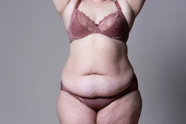 Bříško, rozzáblě kůže na tlustým břicha, koncept plastického chirurgického zákroku — Stock fotografie