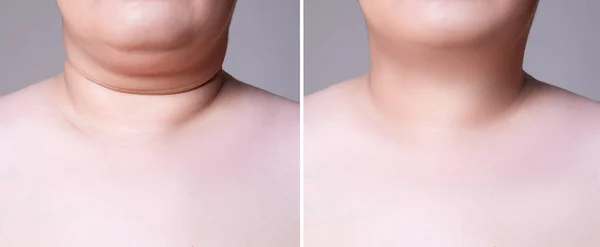 Ringiovanimento della pelle sul collo, prima dopo il concetto anti invecchiamento, trattamento delle rughe, lifting facciale e chirurgia plastica — Foto Stock