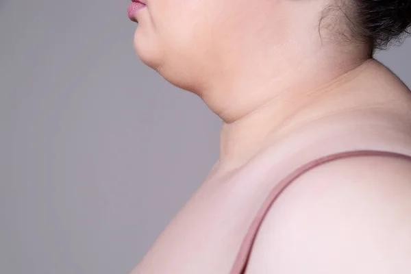 Πλαδαρό δέρμα στο λαιμό μιας χοντρής γυναίκας, θηλυκό διπλό πηγούνι σε γκρι φόντο — Φωτογραφία Αρχείου