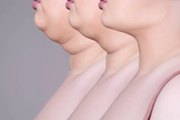 Double chin, skin rejuvenation on the neck, before after anti aging concept — Stock Photo, Image