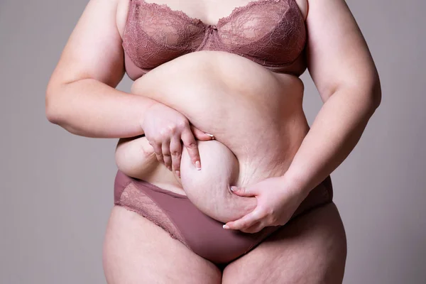 Abdominoplastia, piel flácida en un vientre gordo, concepto de cirugía plástica —  Fotos de Stock