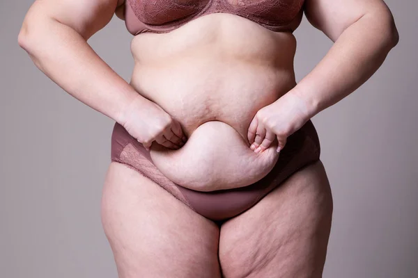 Tummy tuck, flabby skin on a fat belly, plastic surgery concept