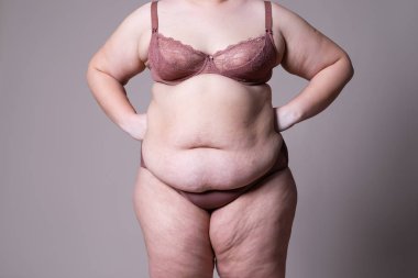 Tummy Tuck, yağlı göbek üzerinde gevşek cilt, plastik cerrahi kavramı