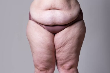 Tummy Tuck, yağlı göbek üzerinde gevşek cilt, plastik cerrahi kavramı