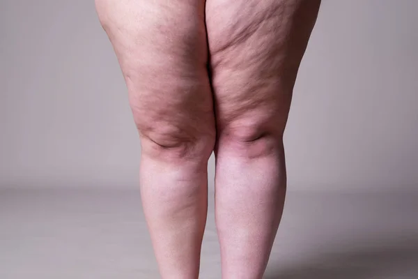 Donna in sovrappeso con gambe grasse, obesità corpo femminile — Foto Stock