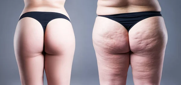 Mulher com excesso de peso com pernas gordas e nádegas, antes após o conceito, obesidade corpo feminino, visão traseira — Fotografia de Stock