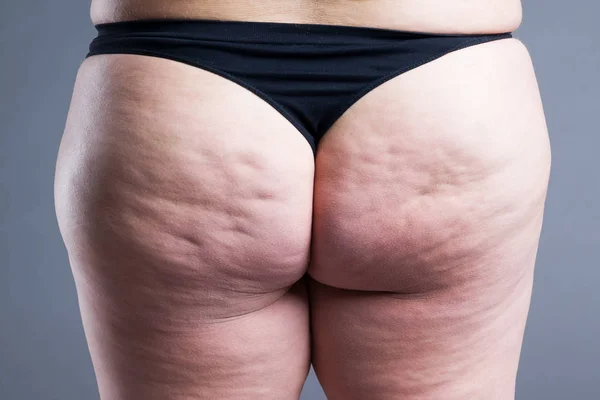 Vet vrouwelijk lichaam met cellulitis, overgewicht heupen en billen — Stockfoto