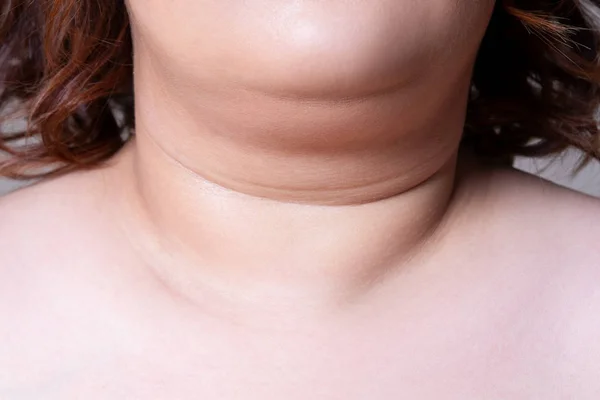 Pele flácida no pescoço de uma mulher gorda, queixo duplo feminino em fundo cinza — Fotografia de Stock