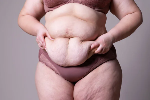 Tummy tuck, flabby skin on a fat belly, plastic surgery concept