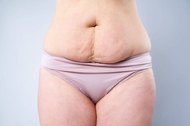Tummy Tuck, yağlı göbek üzerinde gevşek cilt, plastik cerrahi kavramı