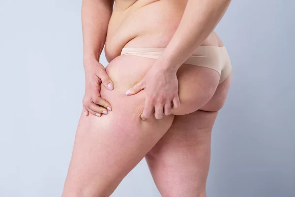 Mulher com excesso de peso com coxas gordas, pernas femininas obesidade — Fotografia de Stock