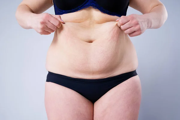 Tummy Tuck, slappe huid op een dikke buik, plastische chirurgie concept — Stockfoto