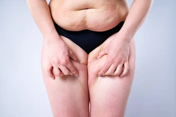 Mulher com excesso de peso com coxas gordas, pernas femininas obesidade — Fotografia de Stock