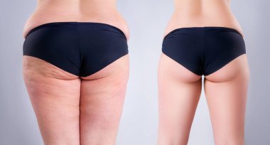 Kilolu bacakları ve kalçaları olan şişman bir kadın, kilo verme kavramından önce, gri arka planda obezite kadın vücudu.