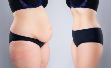 Woman's belly before and after weight loss on gray background, plastic surgery concept clipart
