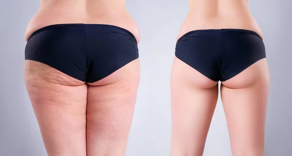 Donna Sovrappeso Con Gambe Grasse Glutei Prima Dopo Concetto Perdita — Foto Stock