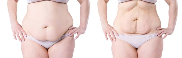 Женское Тело После Потери Веса Изолированы Белом Фоне Концепция Пластической — стоковое фото