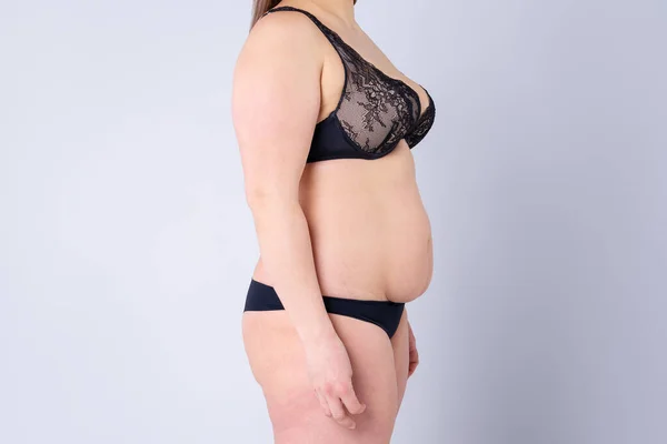 Tummy Tuck Pelle Flaccida Una Pancia Grassa Concetto Chirurgia Plastica — Foto Stock