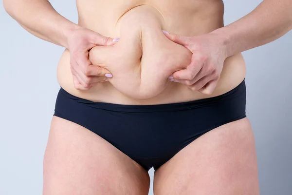 Tummy Tuck Zwiotczała Skóra Brzuchu Koncepcja Chirurgii Plastycznej Szarym Tle — Zdjęcie stockowe