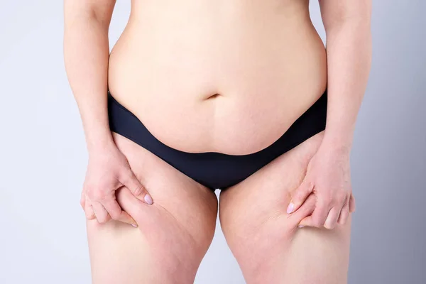 Tummy Tuck Petyhüdt Bőr Egy Kövér Has Plasztikai Sebészet Koncepció — Stock Fotó