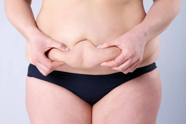 Tummy Tuck Zwiotczała Skóra Brzuchu Koncepcja Chirurgii Plastycznej Szarym Tle — Zdjęcie stockowe