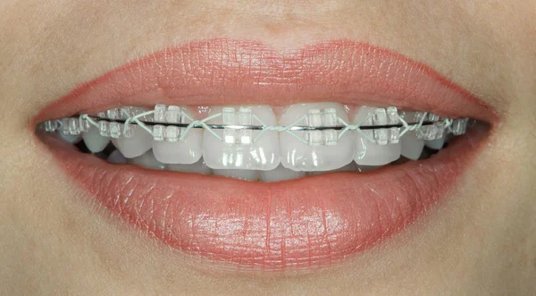 Teeth with ceramic braces — Stock Photo, Image