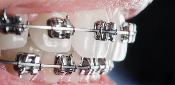 Nahaufnahme Zahnspangen an den Zähnen. Kieferorthopädische Behandlung — Stockfoto