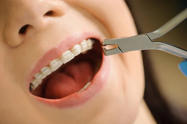 Donna con bretelle in ceramica sui denti nello studio dentistico — Foto Stock