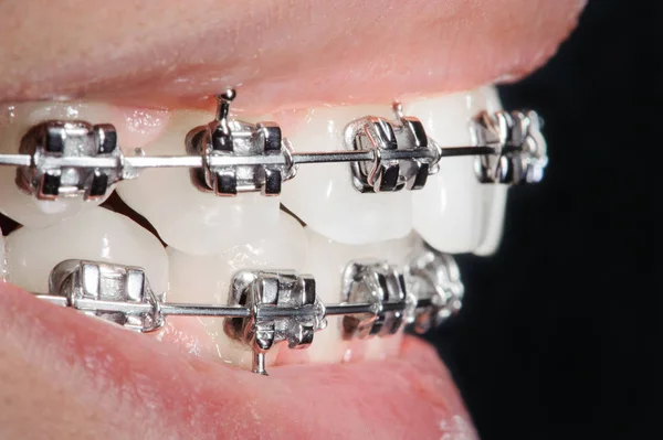 Apparecchi dentali da primo piano sui denti. Trattamento ortodontico — Foto Stock