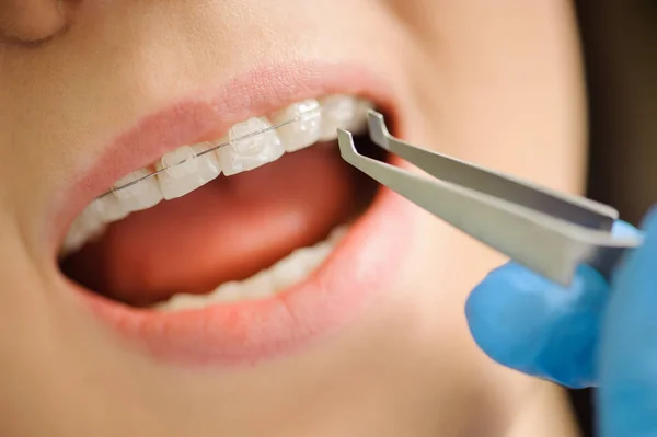 Woman with ceramic braces on teeth at the dental office