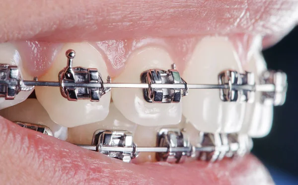 Крупним планом зубні брекети на зубах. ортодонтичного лікування — стокове фото