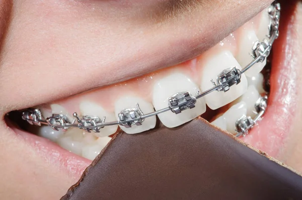 Teeth with dental braces biting chocolate — Stock Photo, Image